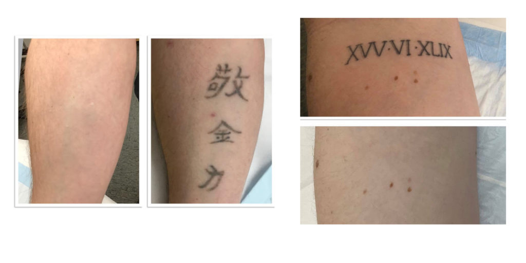 Laser Tattoo Removal NYC, Manhattan & Queens | Glamoi Med Spa